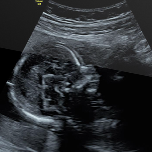 ultrassom-obstetrico